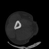 SPORK, NICO - 22.03.1976 - 02.08.2022 - CT obere Extremität - 17:51:17
